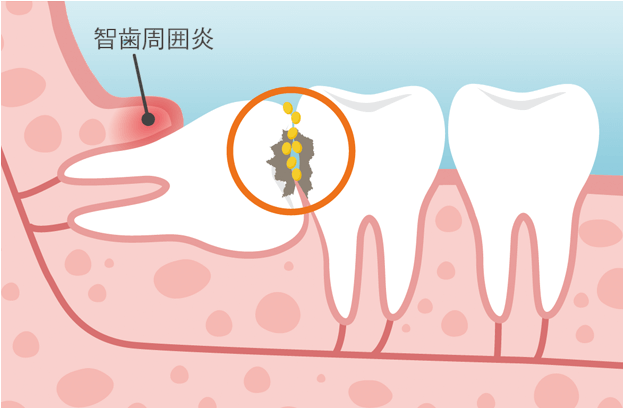 智歯周囲炎